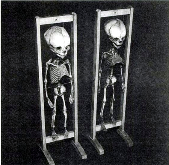 Zwei Skelette von unter der Geburt verstorbenen, ausgetragenen Zwillingen, das Skelett eines Knaben, eines Mädchens 